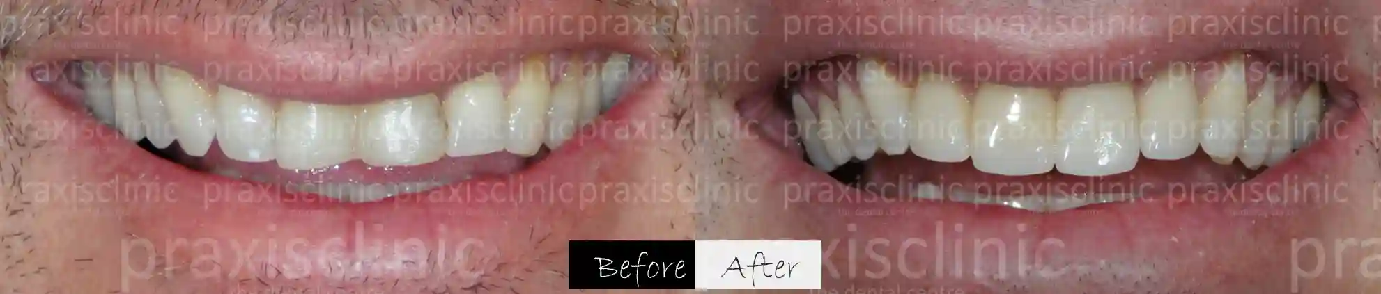 Before and After results of Dental Makeover at Praxis, best dental clinic, leading choice of celebrities in Mumbai
